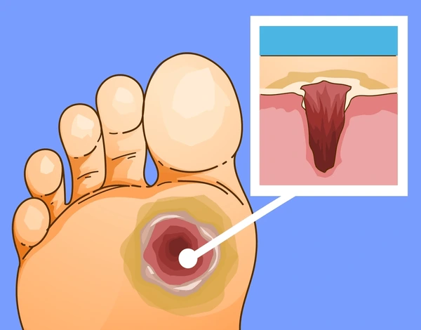 Diabetic foot treatment