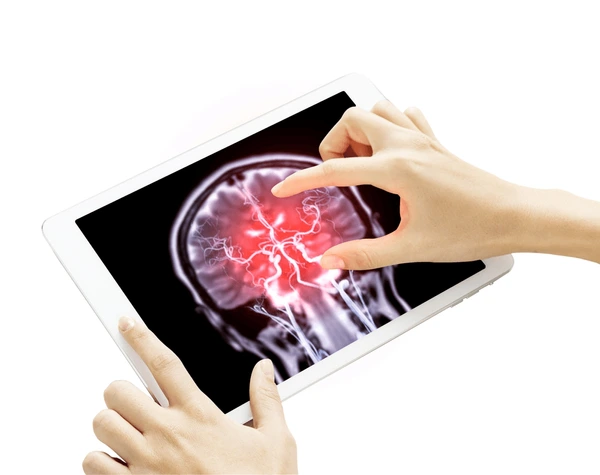 Brain Aneurysm​