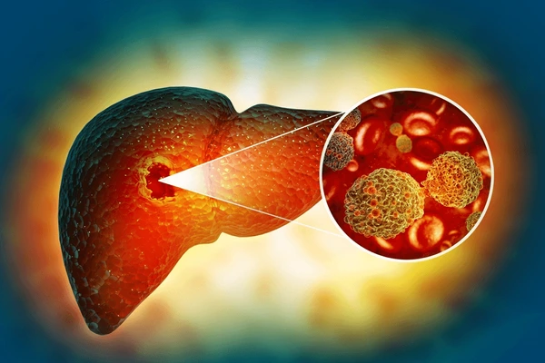 liver cancer treatment in mumbai
