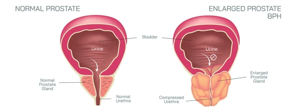 prostate enlargement treatment in mumbai