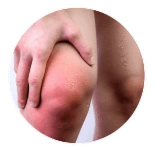 swollen knee joint