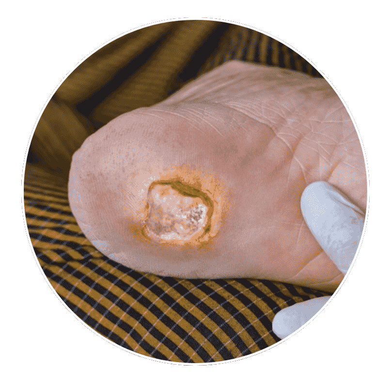 foot ulcers or open sores