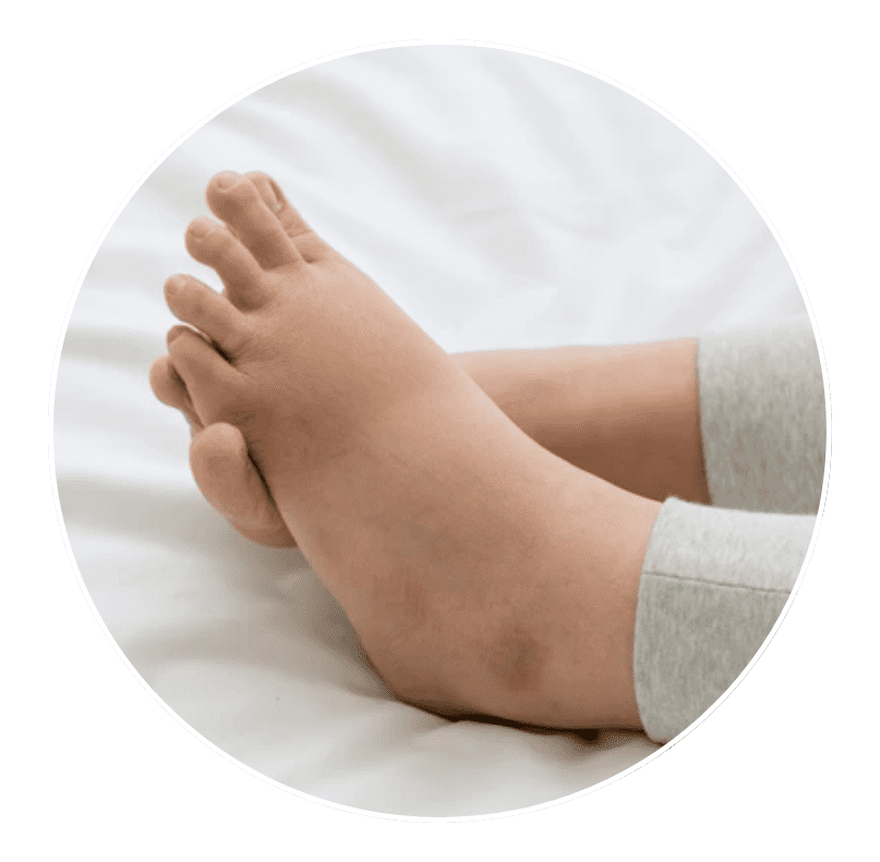 swelling of foot or ankle