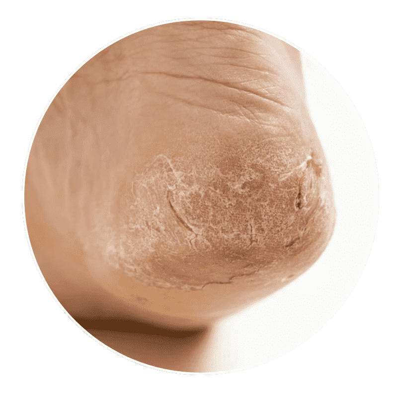 dry and cracked skin