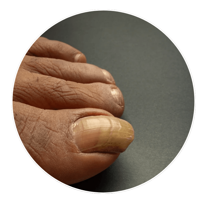 ingrown nails