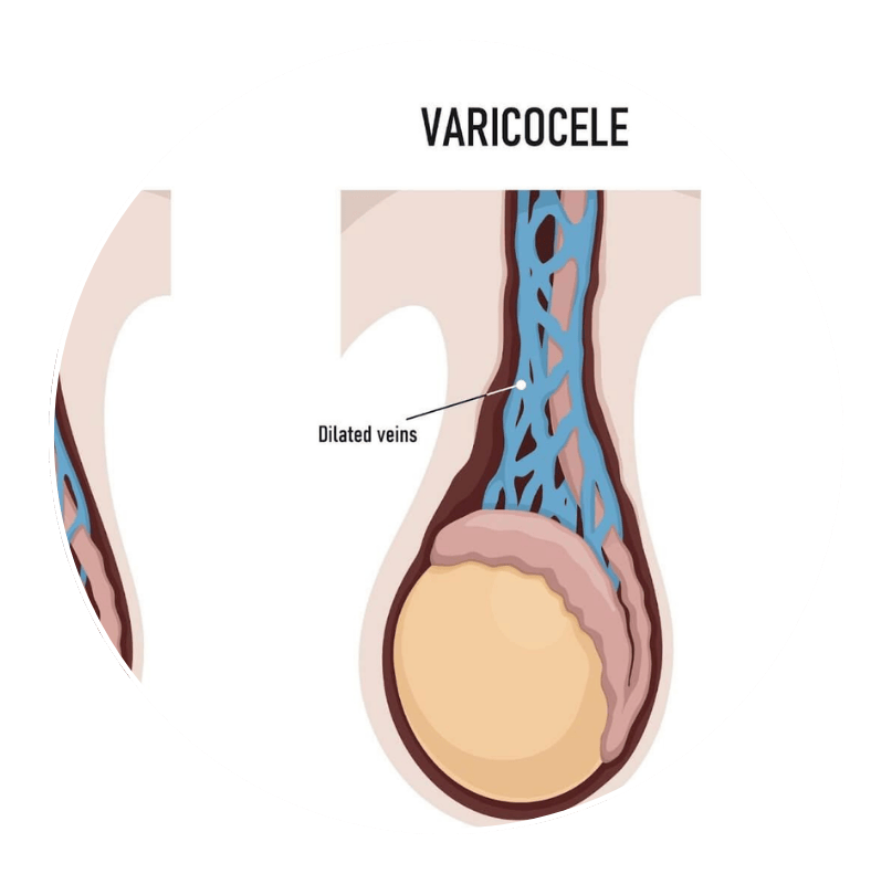 swelling or lump in the scrotum ​