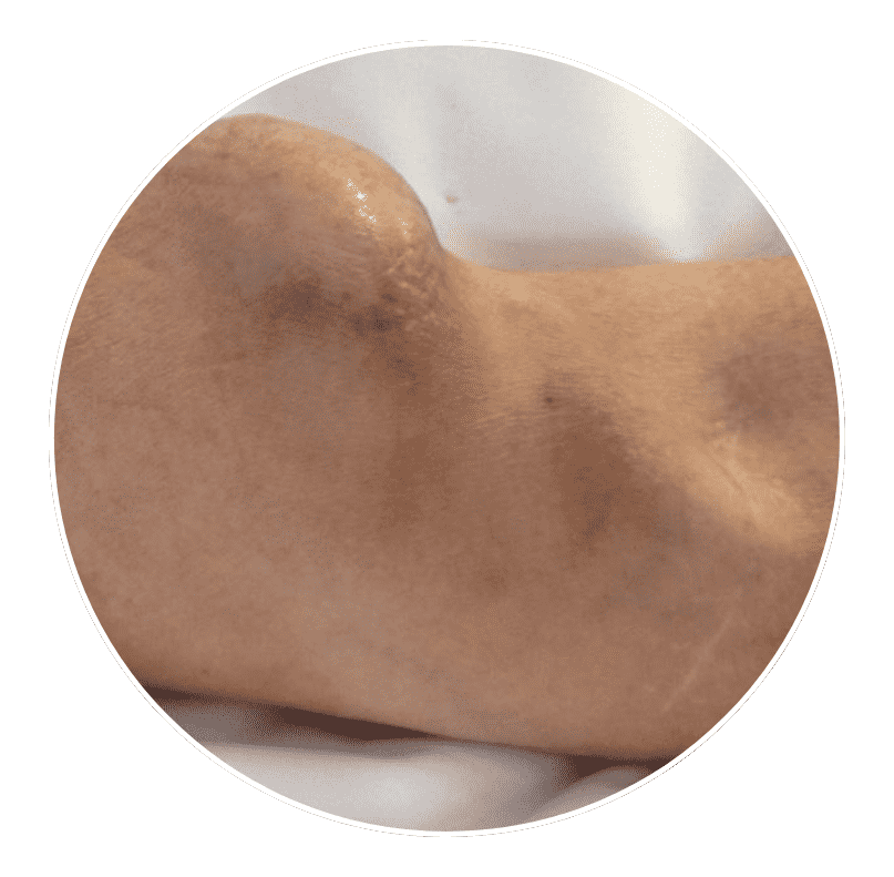 swelling around the fistula