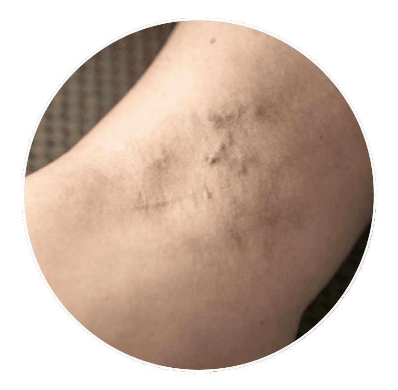bulging or enlarged vein