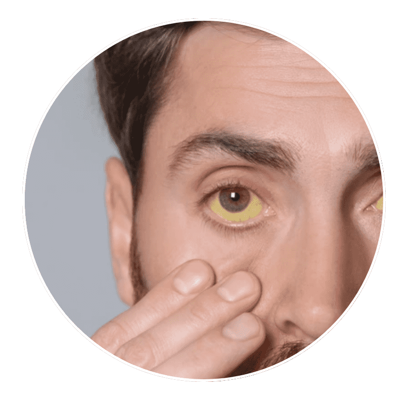 jaundice
