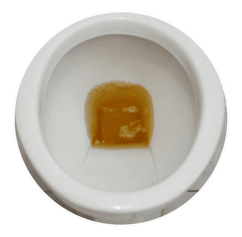 dark urine and pale stools​
