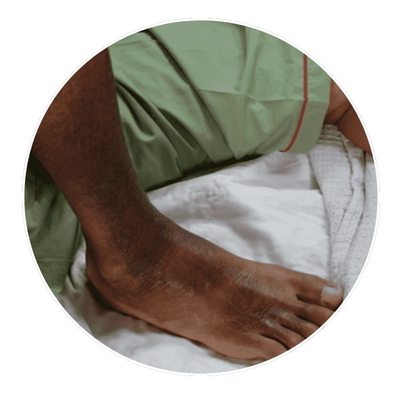 skin discoloration and ulcers