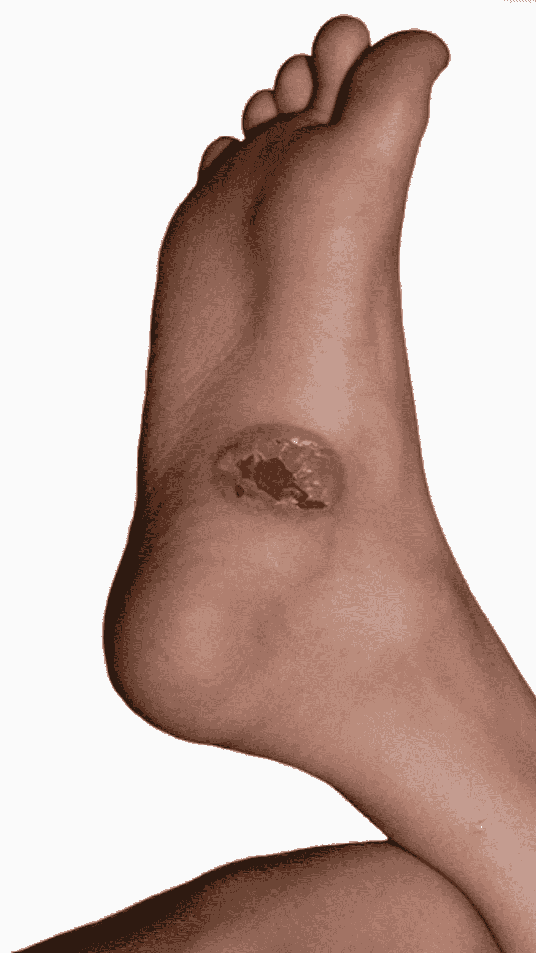 diabetic foot