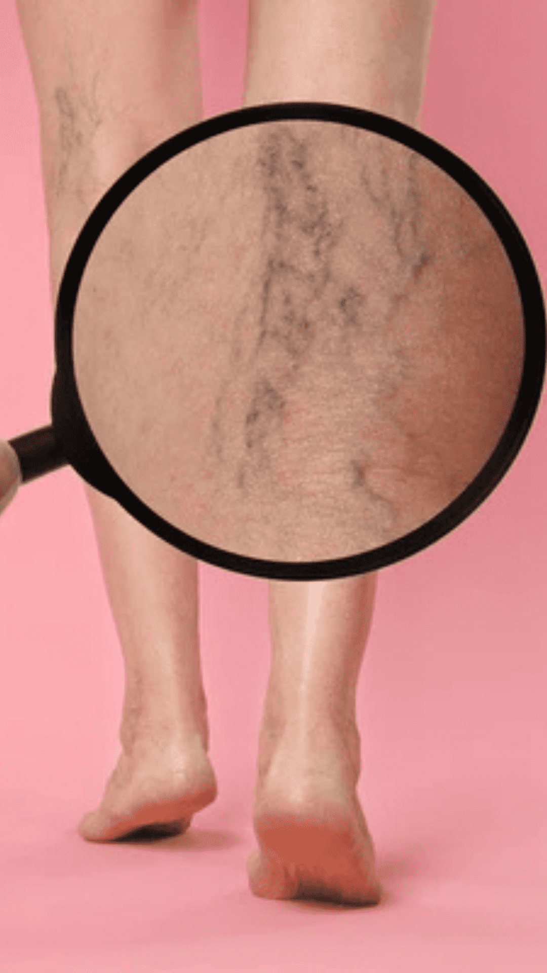 varicose veins disease