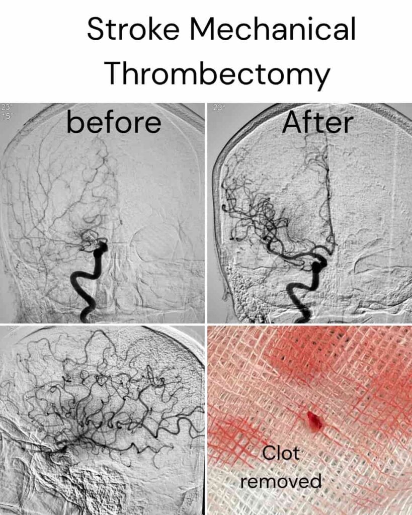 iv treatment and thombectomy