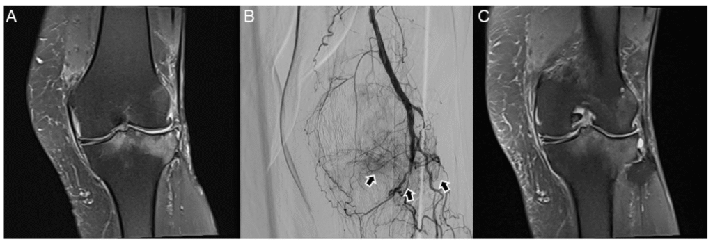 inflamed joint tissues