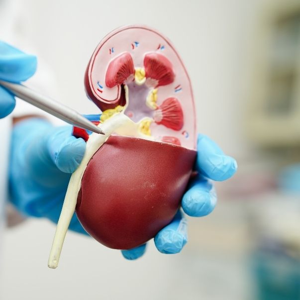 Bladder Stones