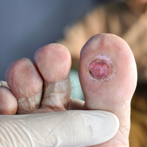 Treatment Options For Diabetic Foot