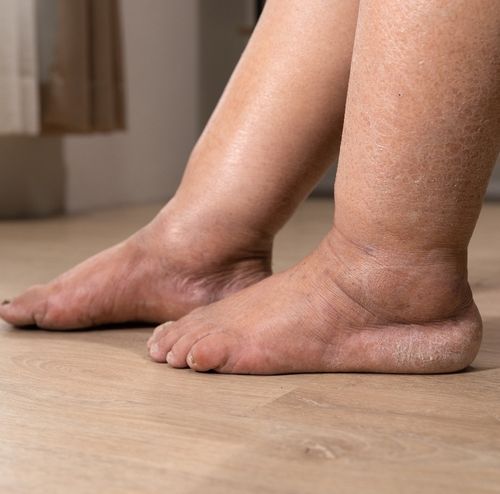 diabetic foot treatment in India