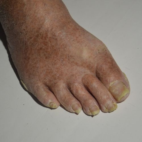 Foot Ulcers or Open Sores