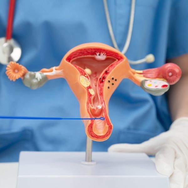 What Causes Uterine Fibroids?