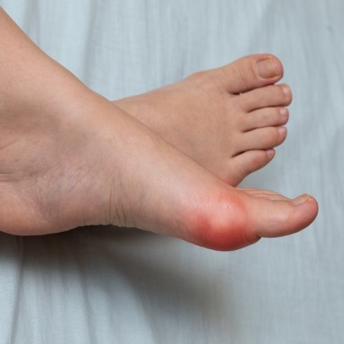 Swelling of the Foot or Ankle
