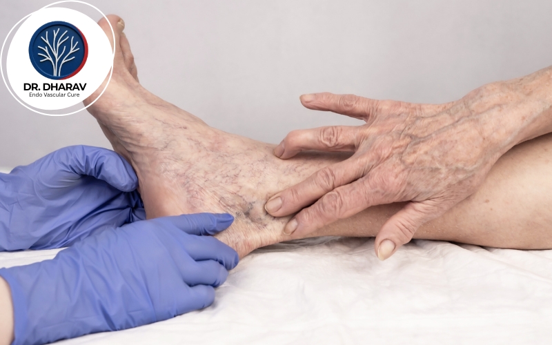 venous ulcer